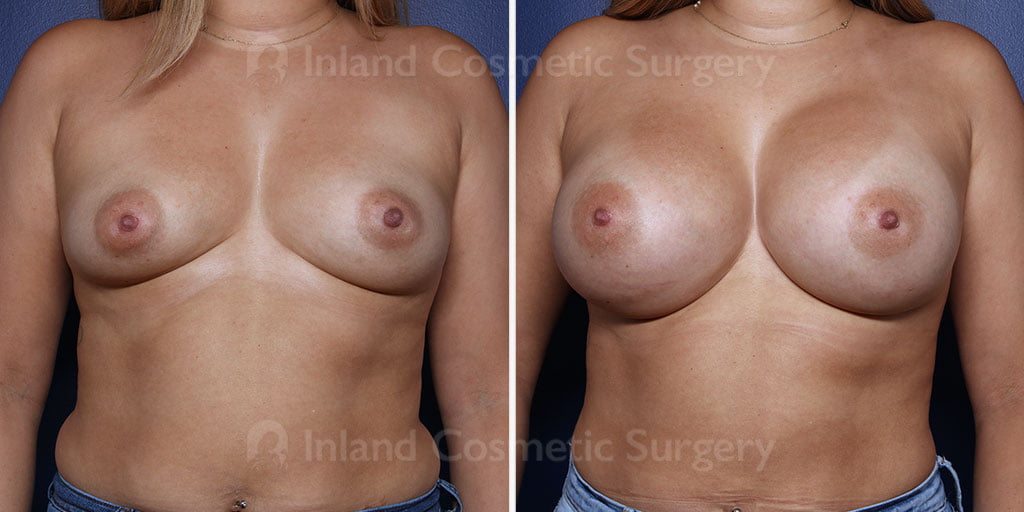 Inland Cosmetic Surgery in Rancho Cucamonga breast augmentation
