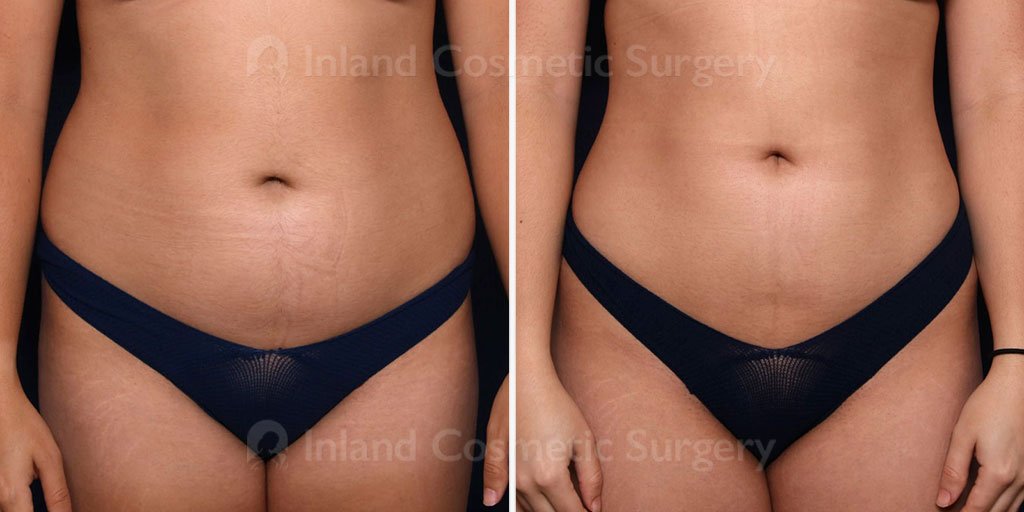 brazilian-butt-lift-liposuction-22223a-inlandcs