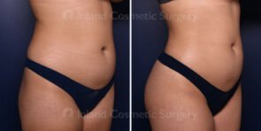 brazilian-butt-lift-liposuction-22223b-inlandcs