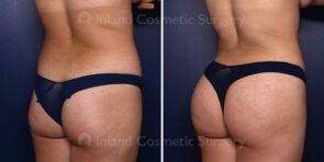 Liposuction and Fat Transfer to the Buttocks