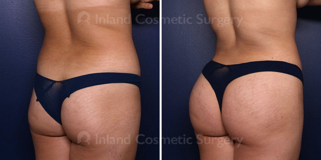 Liposuction and Fat Transfer to the Buttocks