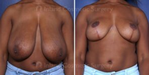 breast-reduction-22162a-inlandcs