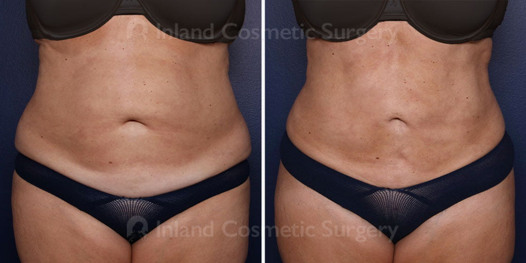 Vaser Hi-Def Liposuction
