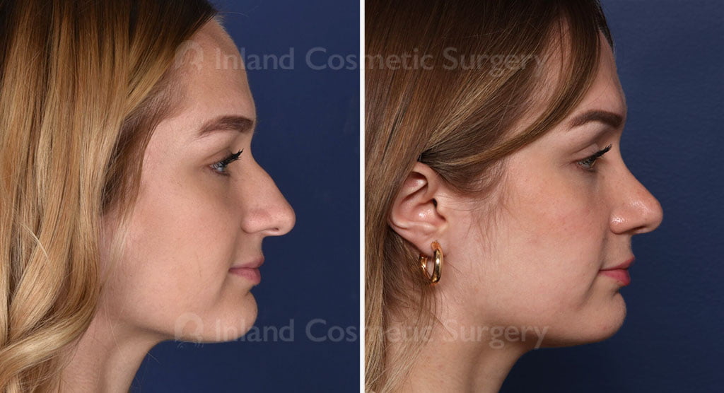 Rhinoplasty Patient