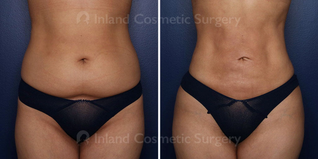 brazilian-butt-lift-liposuction-22178a-inlandcs