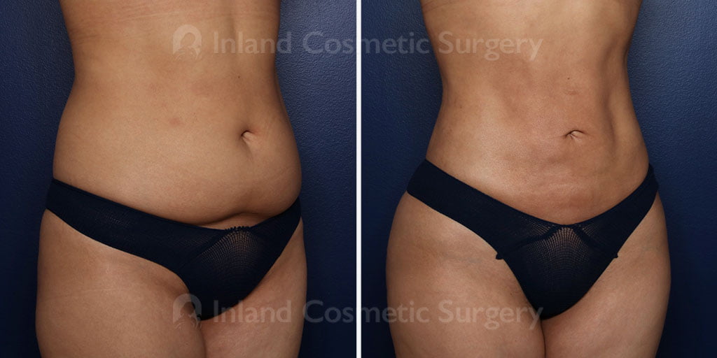 brazilian-butt-lift-liposuction-22178b-inlandcs