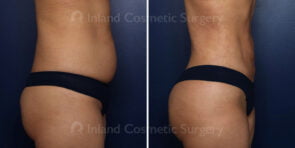 brazilian-butt-lift-liposuction-22178c-inlandcs