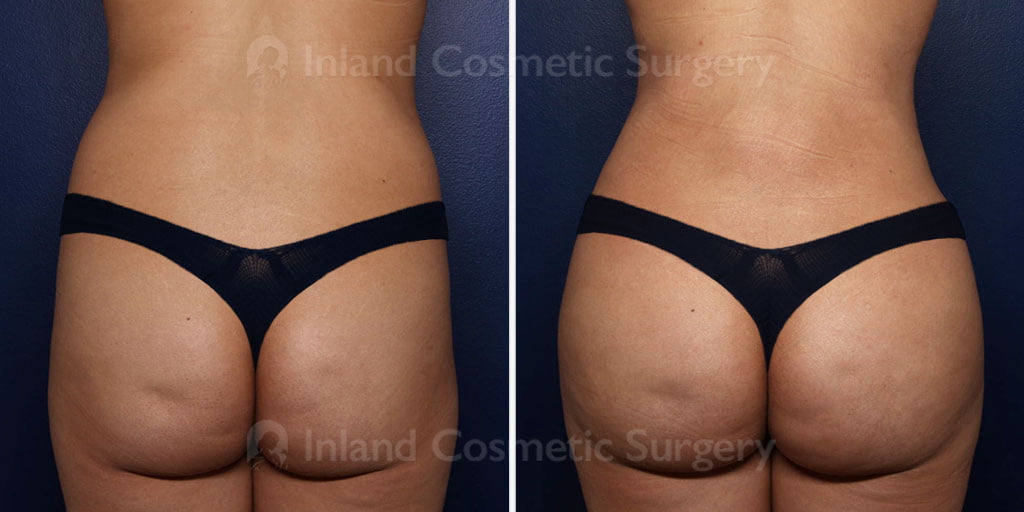 Liposuction and Fat Transfer to the Buttocks