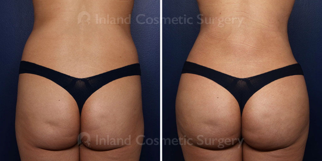 brazilian-butt-lift-liposuction-22178d-inlandcs