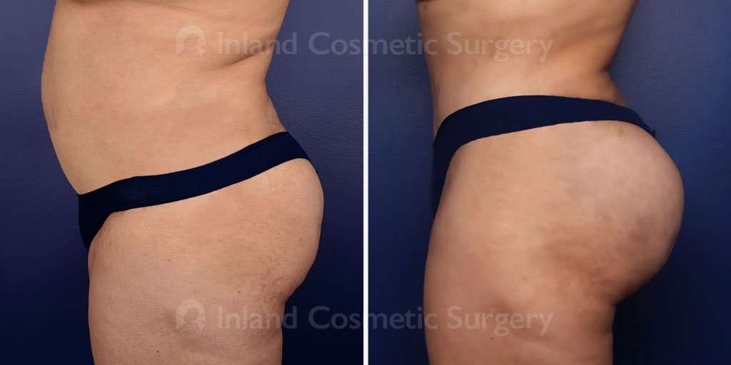 brazilian-butt-lift-tummy-tuck-liposuction-22262c-inlandcs