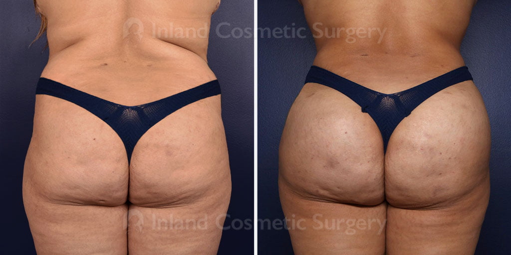 Liposuction and Fat Transfer to the Buttocks