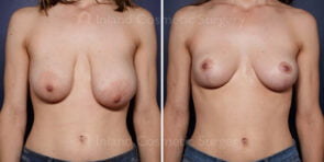breast-reduction-lift-23421a-inlandcs