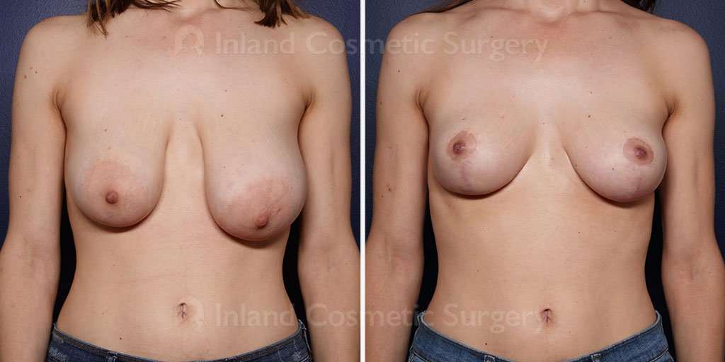 breast-reduction-lift-23421a-inlandcs