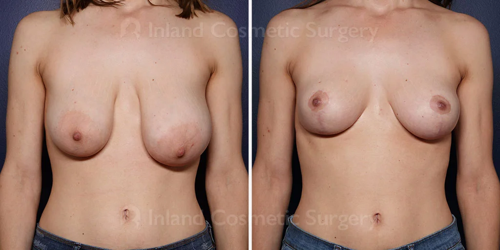 Breast Reduction
