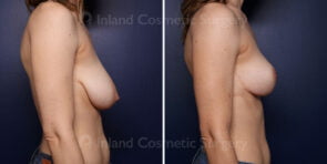 breast-reduction-lift-23421c-inlandcs
