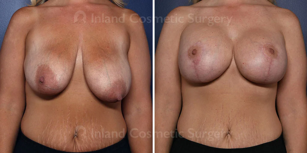 Breast Lift with Augmentation