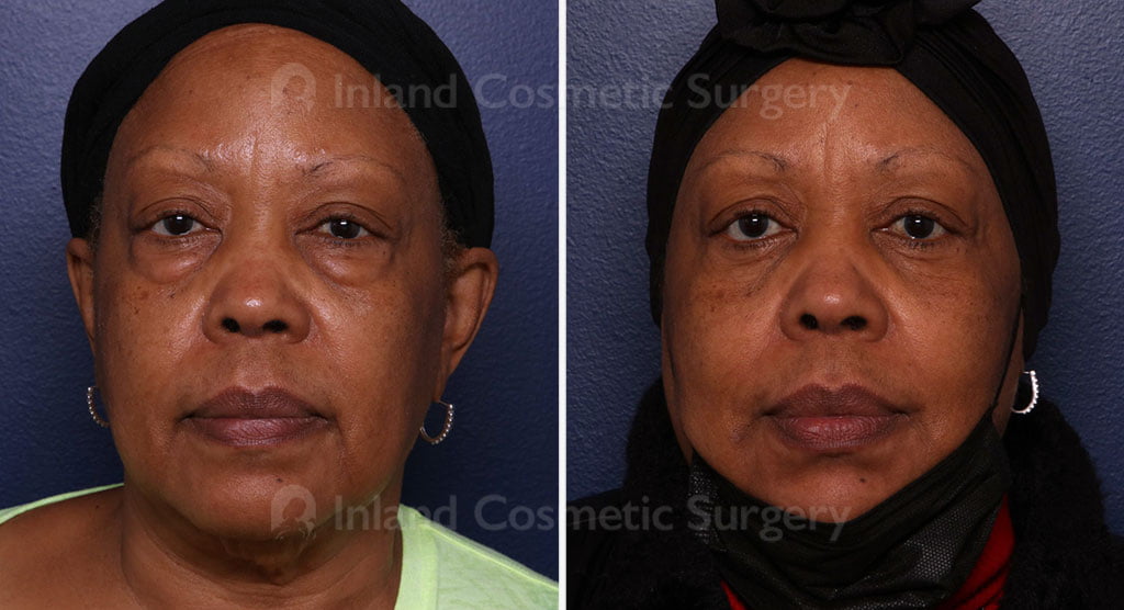 Eyelid Surgery