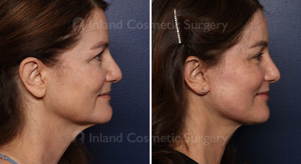 Facial Rejuvenation