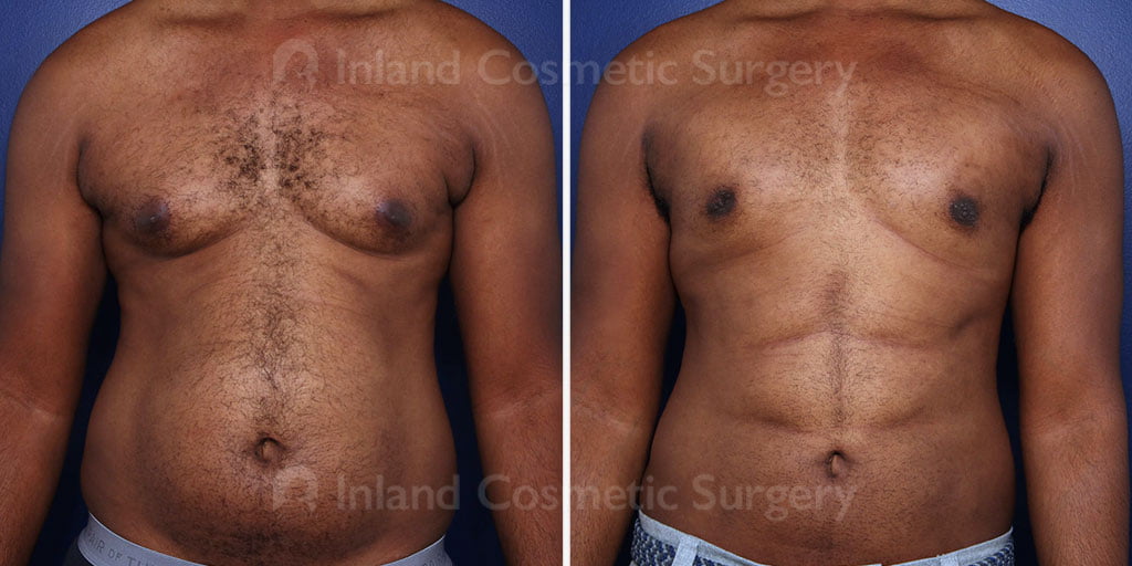 Before and after male breast reduction