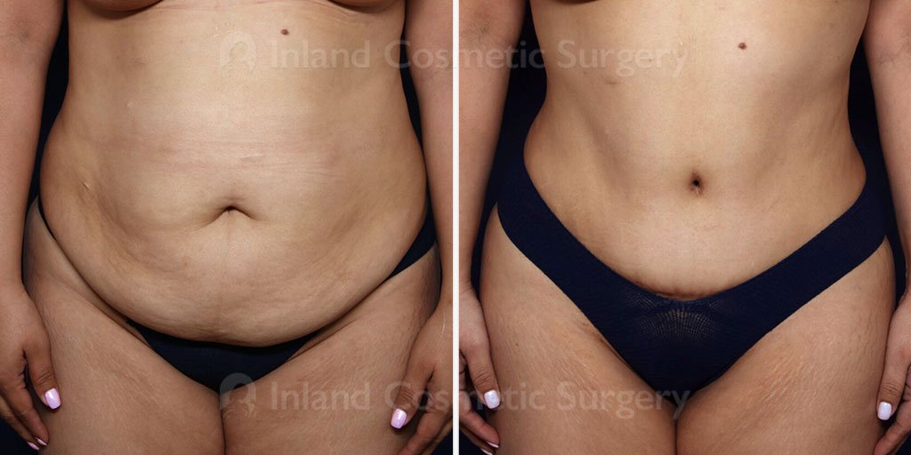 Before and after image of Tummy Tuck patient with lipo to remove additional fat