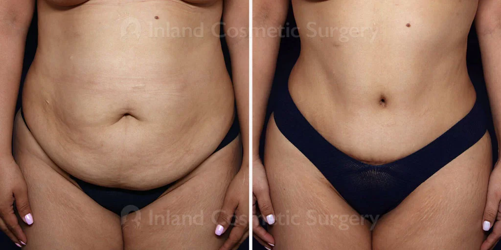 The benefits of TUMMY TUCK may be more than just a trim tummy