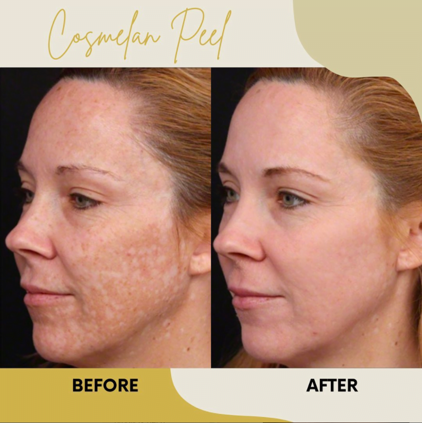 Cosmelan MD Peel Before and After at Ahava Medspa at Inland Cosmetic Surgery