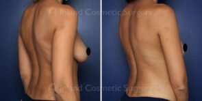 liposuction-back-bra-renuvion-24035c-inlandcs