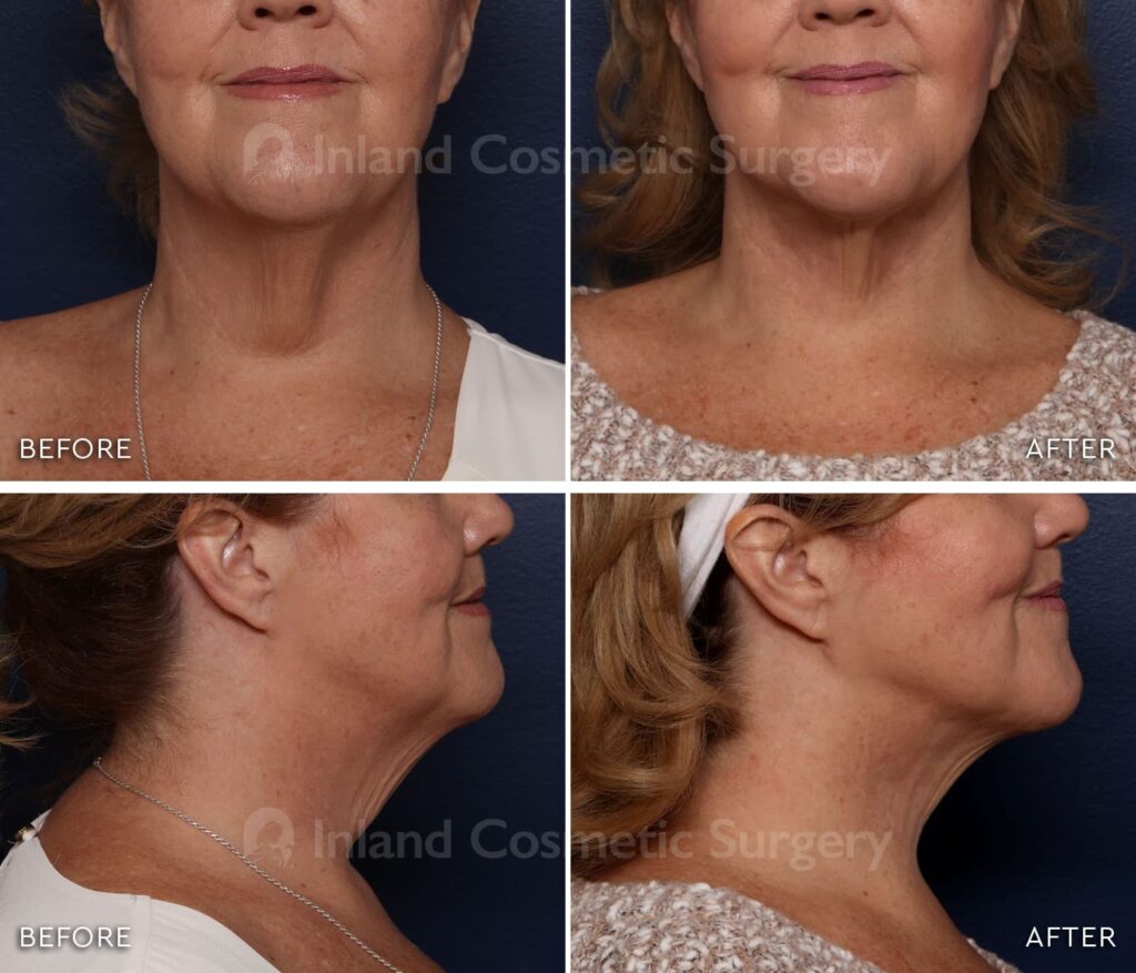 Before and after image of an Inland Cosmetic patient with Renuvion treatment applied to neck