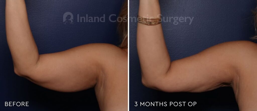 Before and after image of an Inland Cosmetic patient with Renuvion treatment applied to arms