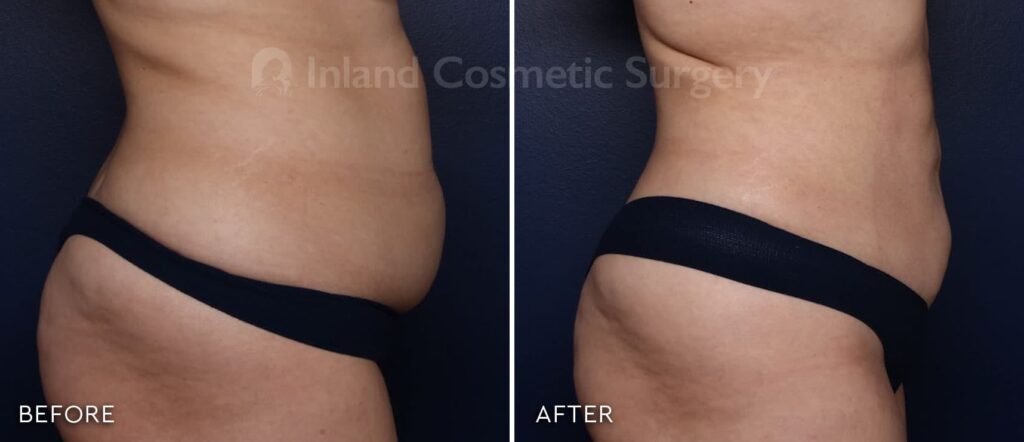 Before and after image of an Inland Cosmetic patient with Renuvion treatment applied to abdomen