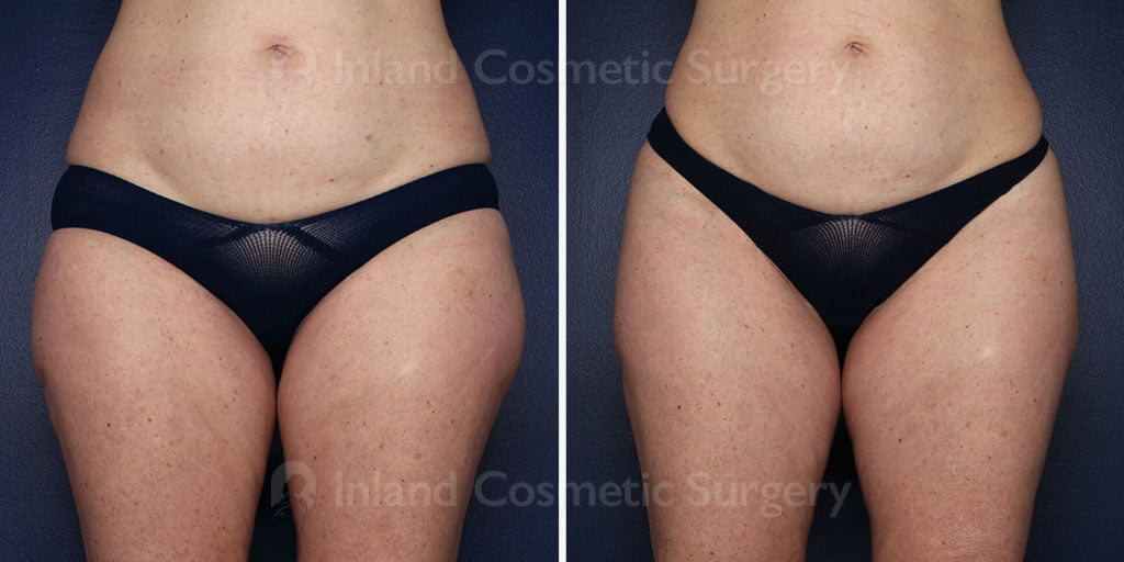 Liposuction and Renuvion