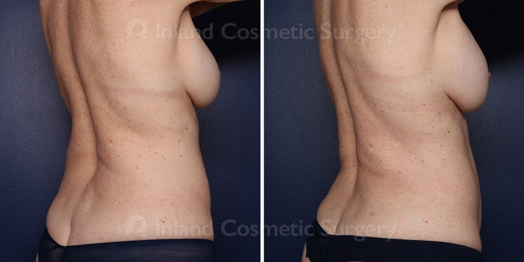 liposuction-renuvion-24050c-inlandcs