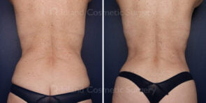 liposuction-renuvion-24050d-inlandcs