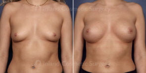 TUBA Breast Augmentation