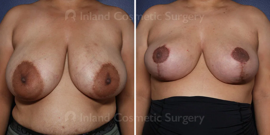 Breast Reduction