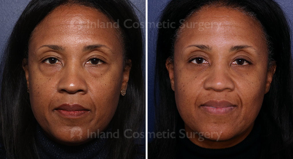 Eyelid Surgery