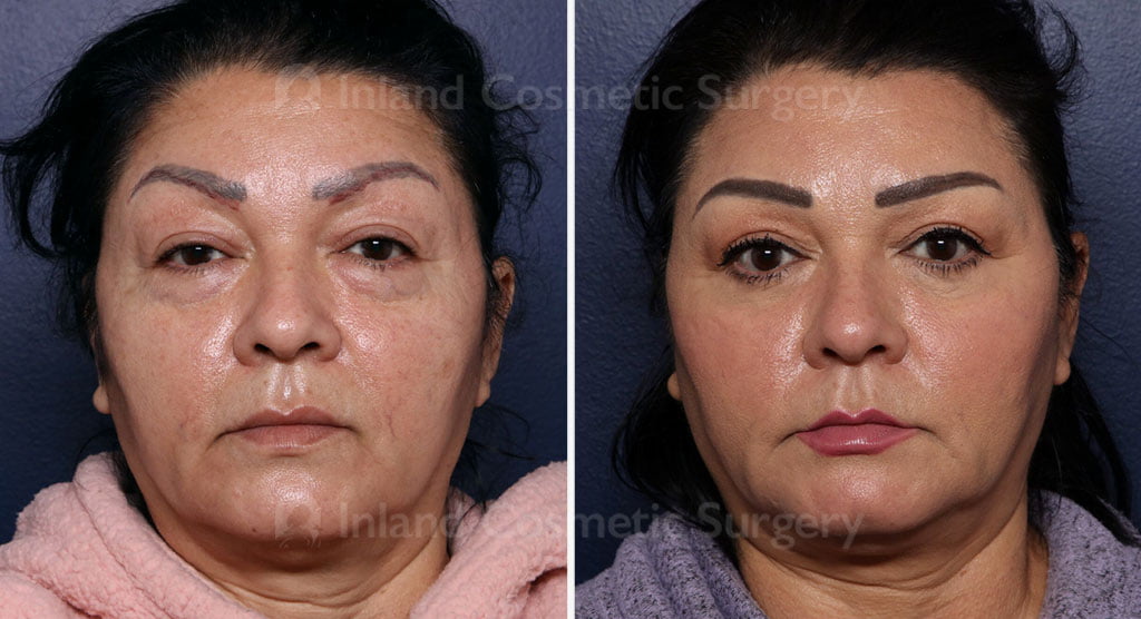 Eyelid Surgery