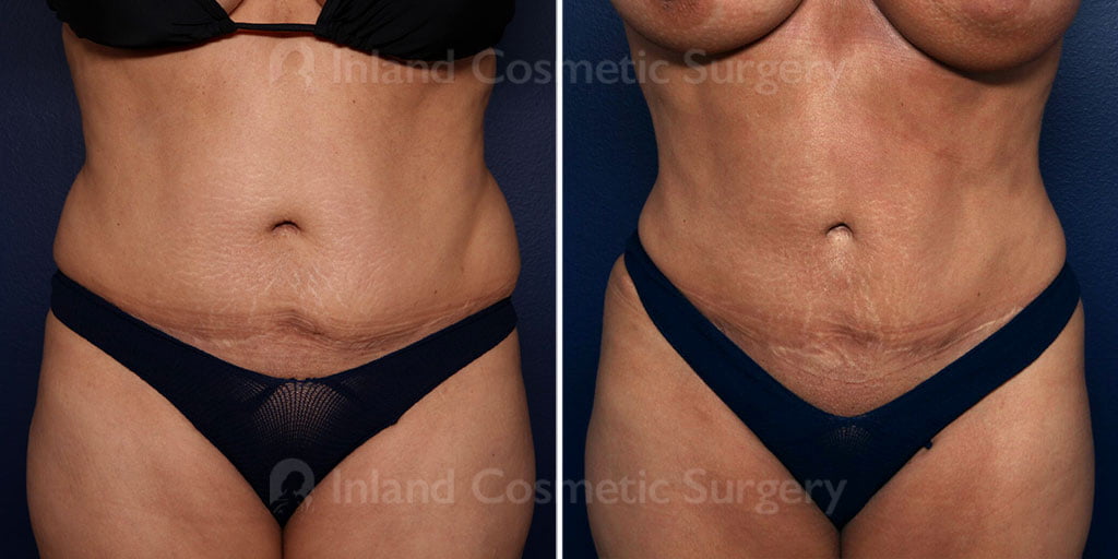 Vaser Liposuction