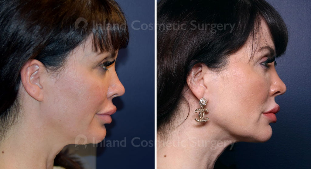 Submental Liposuction with Renuvion