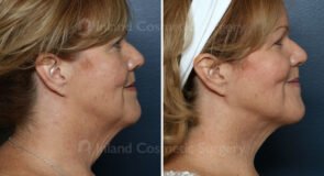 Submental Liposuction with Renuvion
