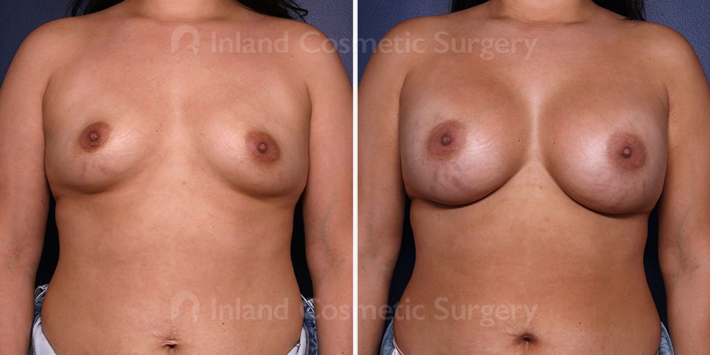 TUBA Breast Augmentation