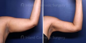 Liposuction Upper Arms