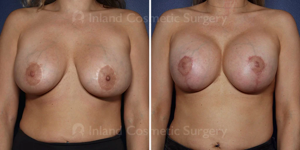 Breast Implant Revision with Lift