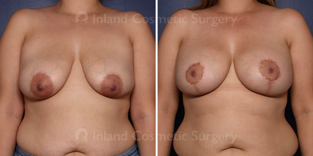 Breast Lift with Augmentation