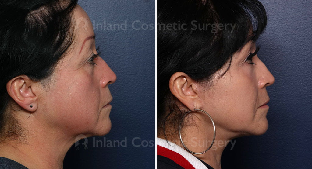 Facial Rejuvenation