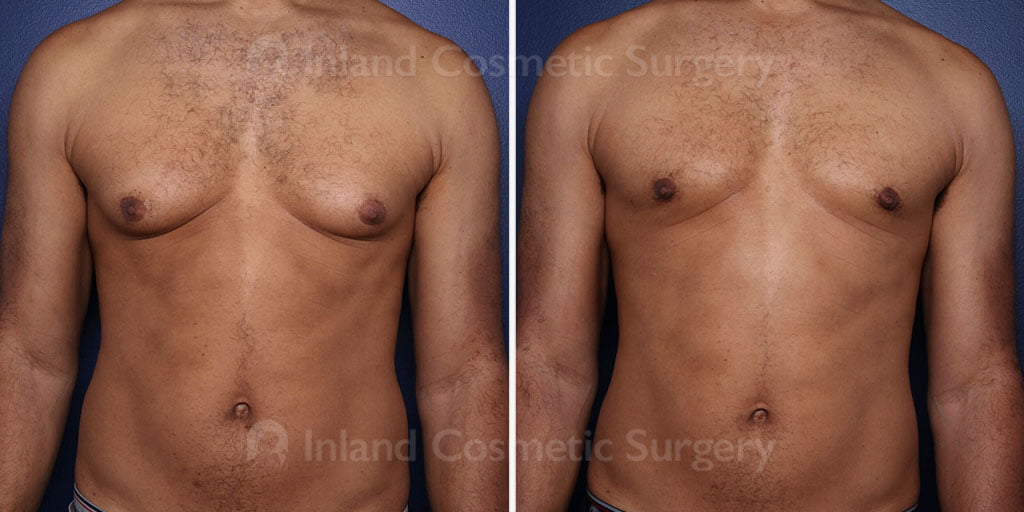 Male Breast Reduction