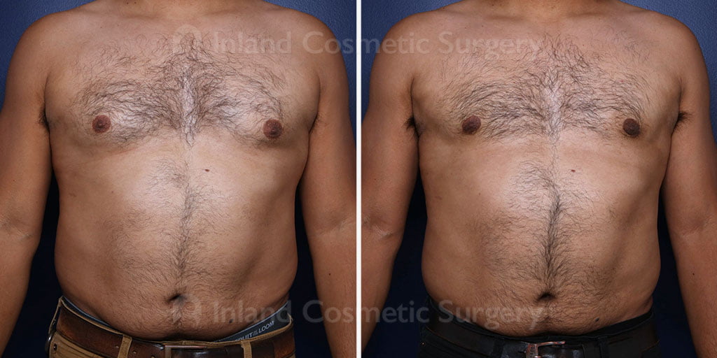 Male Breast Reduction