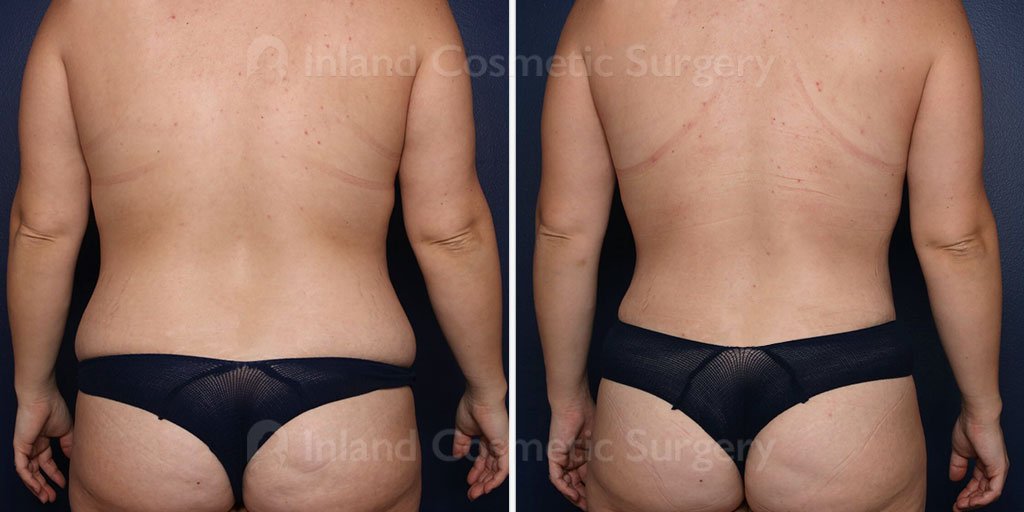 Vaser Liposuction