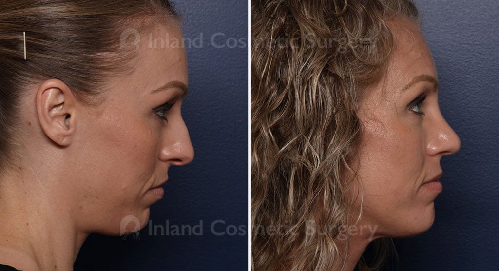 Rhinoplasty Patient