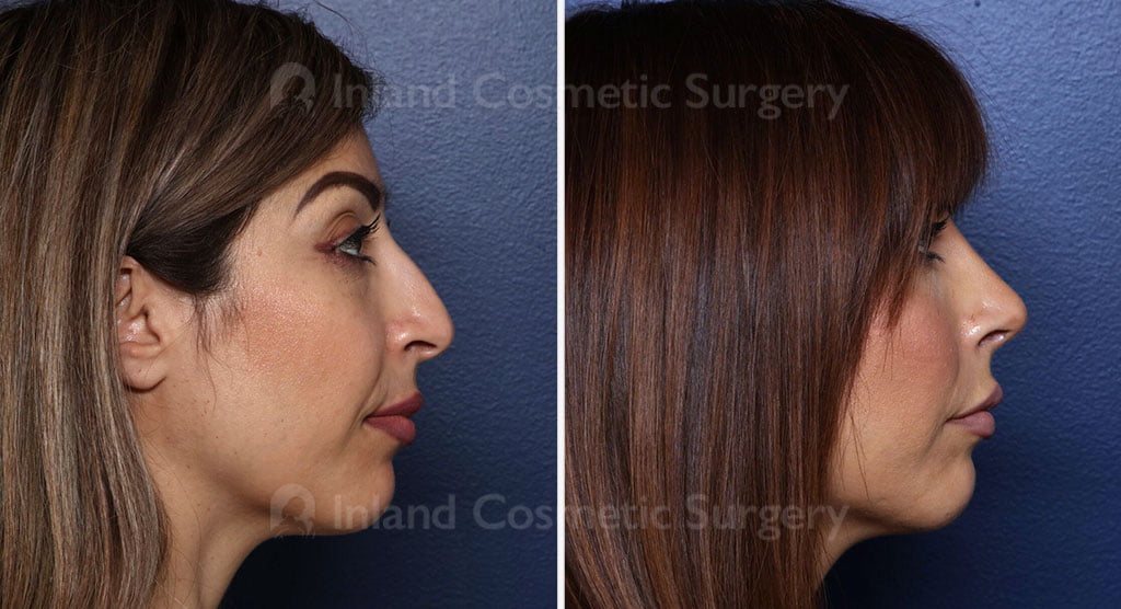 Rhinoplasty and Fat Transfer